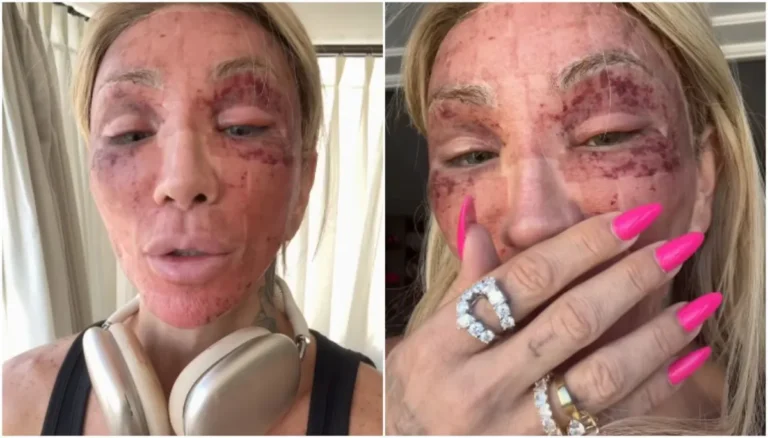 Maya Massafera mostra rosto inchado após peeling